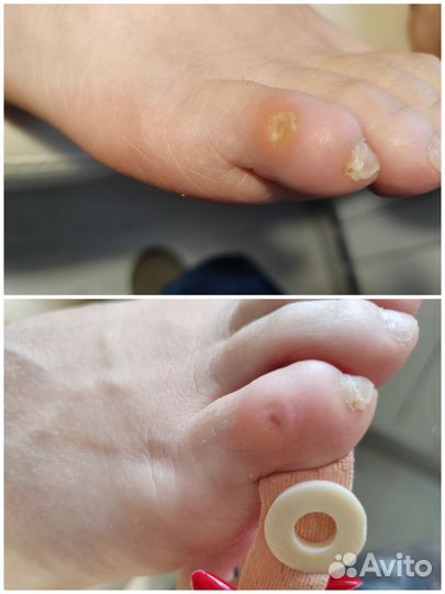 Педикюр подологический