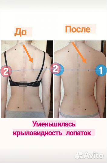 Коррекция осанки, лечение сколиоза, плоскостопие