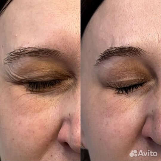 Модель на ботокс лица