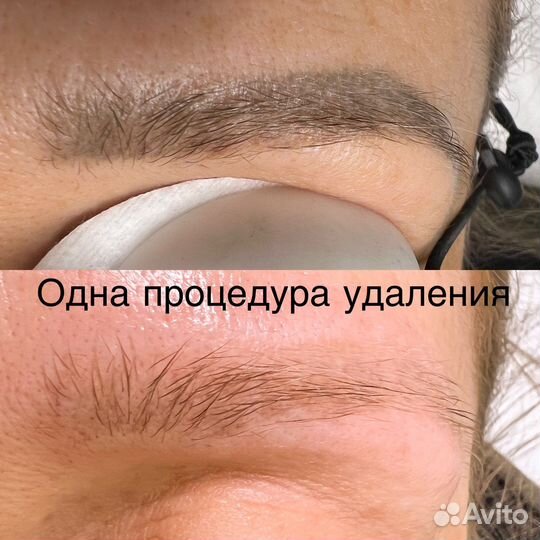 Удаление татуажа и тату лазером Lastik и ремувером