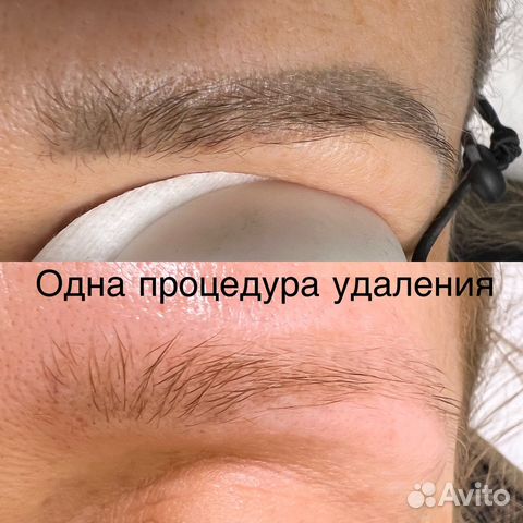 Удаление татуажа и тату лазером Lastik и ремувером