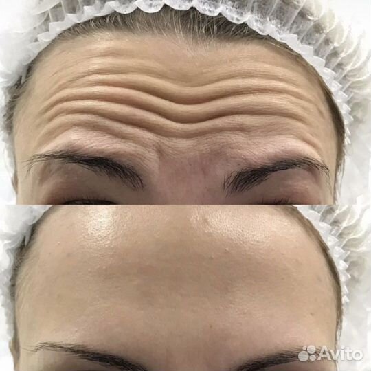 Ботокс для лица, ботулинотерапия