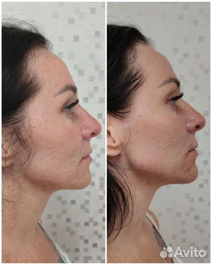 Контурная пластика лица