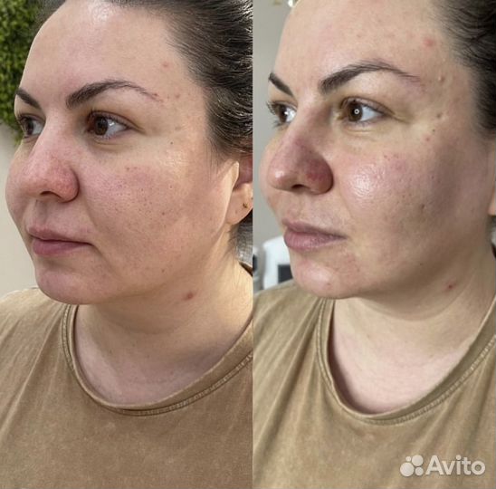 Смас лифтинг