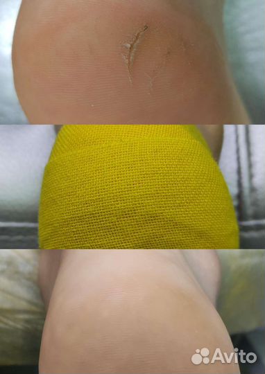 Лечебный педикюр подолог