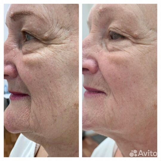 Процедура холодной плазмы/Омоложение