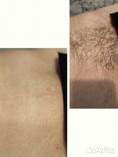 Шугаринг: глубокое бикини