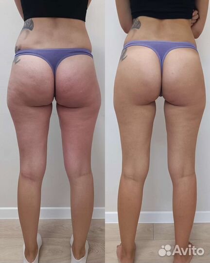 Массаж, ручная липосакция, устранение целлюлита