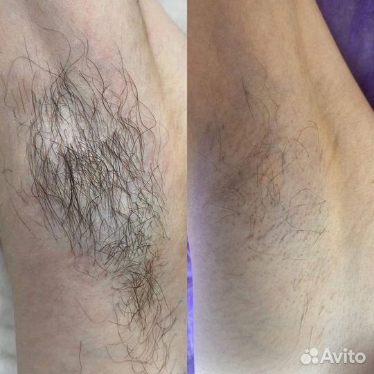Электроэпиляция