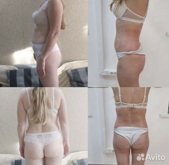 LPG массаж тела и лица