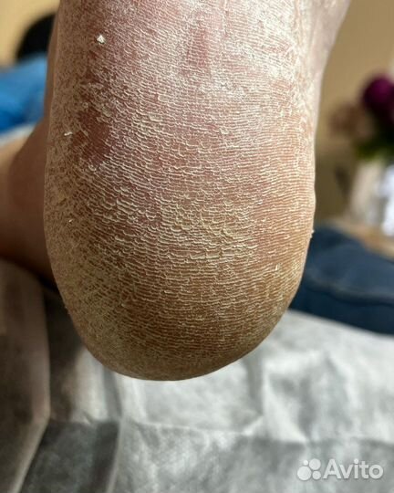 Педикюр, подология