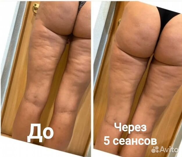 Бесплатно Lpg массаж моделирование. Тест-драйв