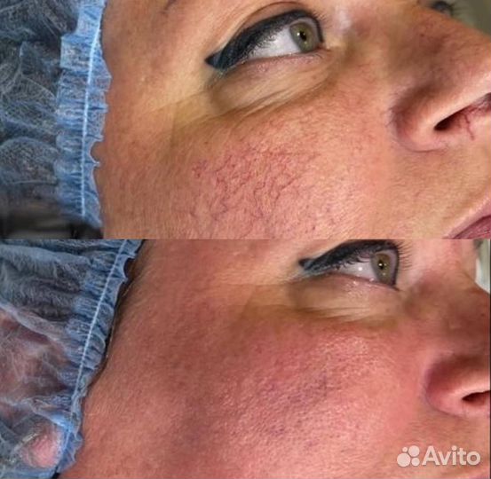 Фотоомоложение люмекка (Lumecca)