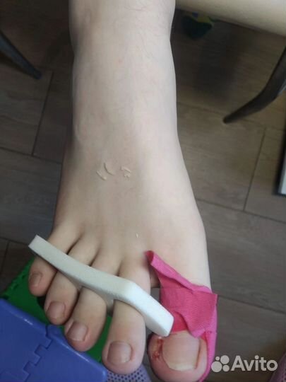 Удаление вросшего ногтя/титановая нить