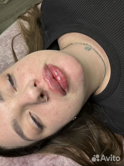 Контурная пластика губ