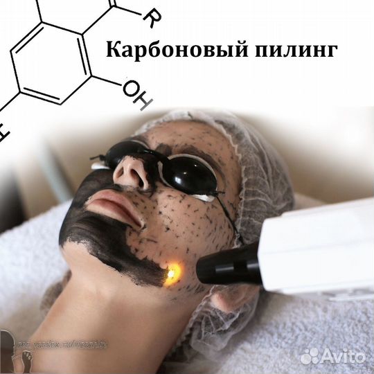 Карбоновый пилинг лазер