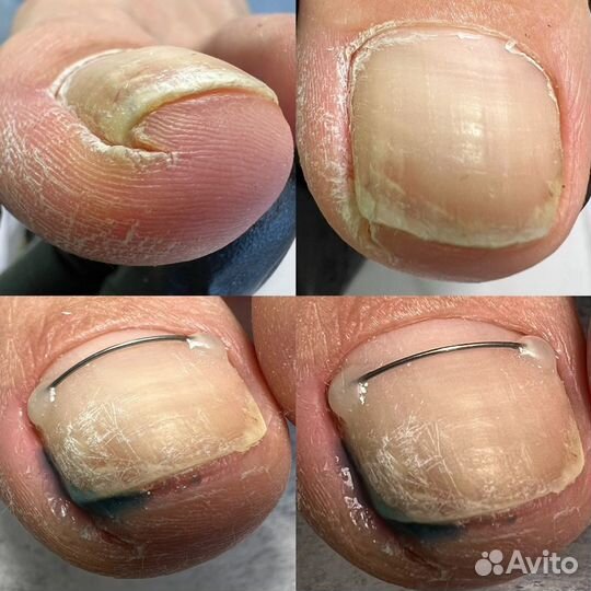 Подолог, педикюр медицинский, вросший ноготь