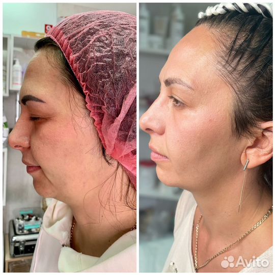 Аппаратное омоложение