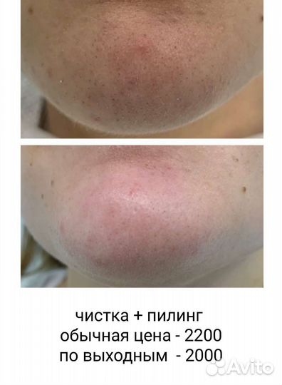 Ультразвуковая чистка лица