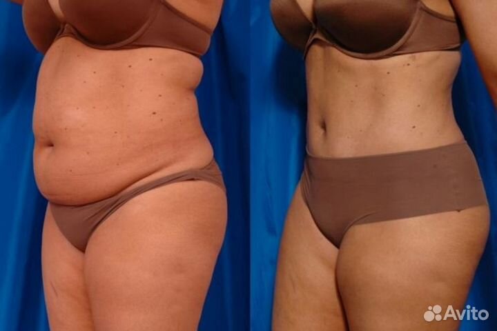 Путь к уменьшению жировой прослойки в Кемерово