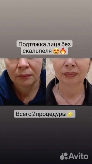 Холодная Плазма