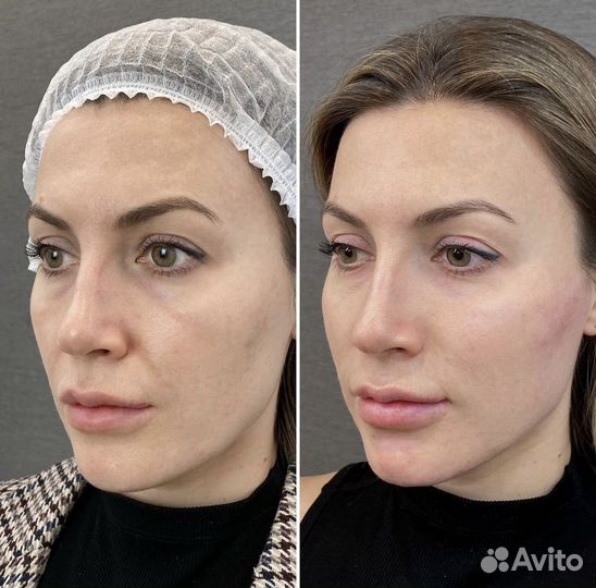 Скульптурный массаж лица