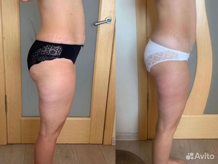 Снижения веса /LPG и Прессотерапия сеанс