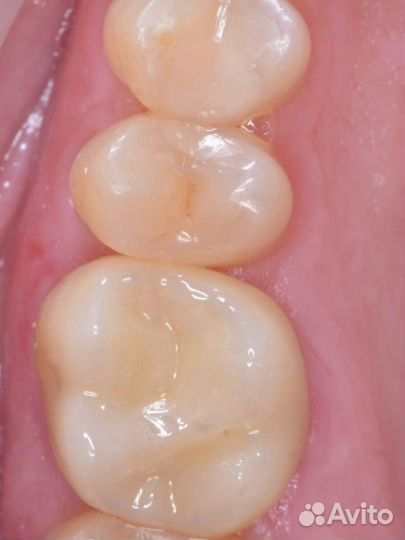 Зубной техник. Коронки, Виниры (Емах, Циркон)