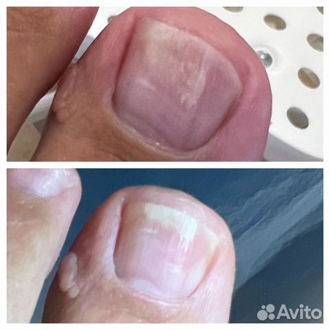 Педикюр сложных стоп