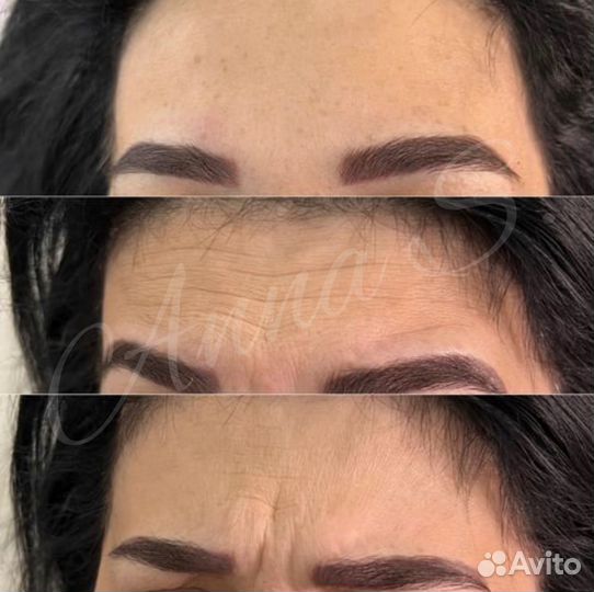 Ботокс для лица