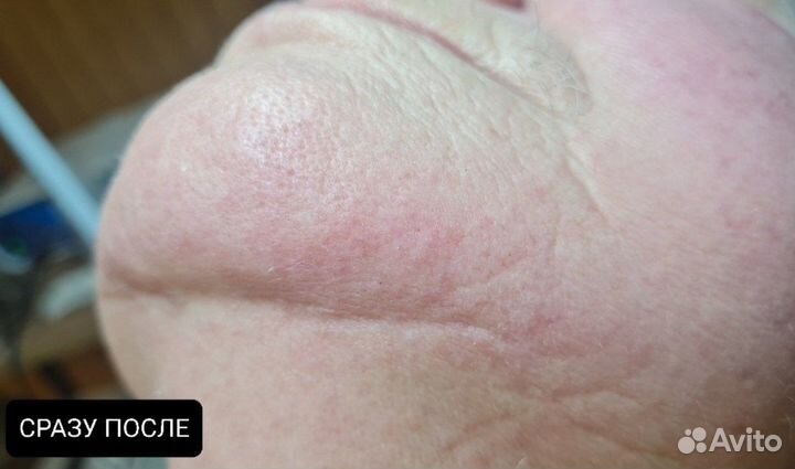 Электроэпиляция