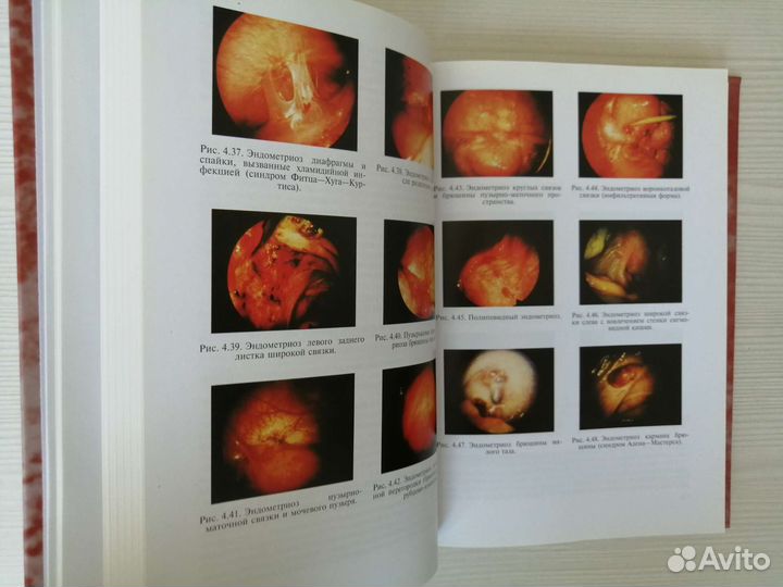 Эндометриозы (2006г.) / Л. Адамян