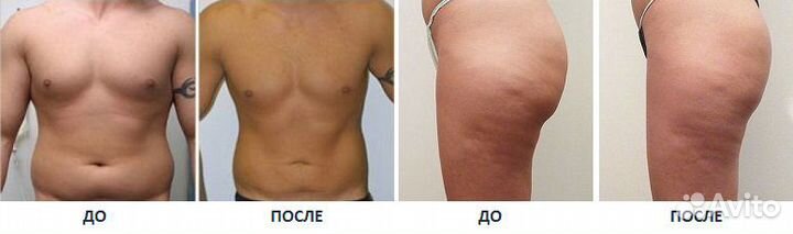 Модель на криолиполиз Coolsculpting