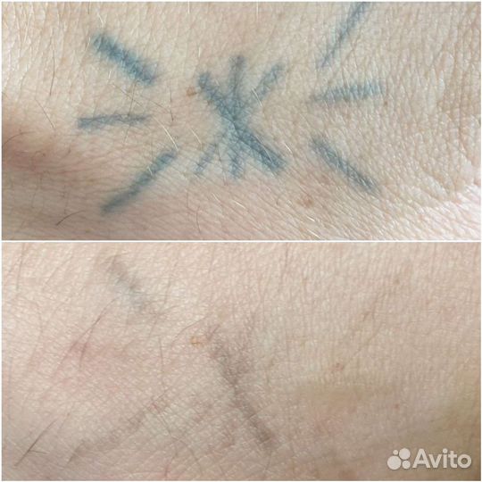 Удаление тату/татуажа