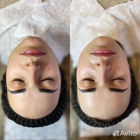 Карбокситерапия