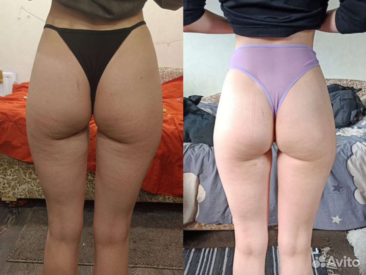 Антицеллюлитный массаж