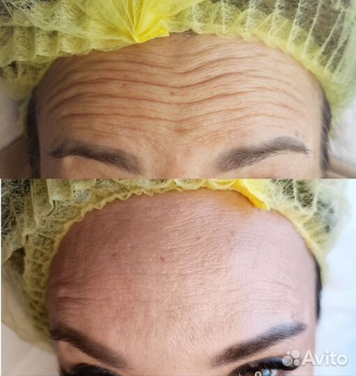 Ботокс лица