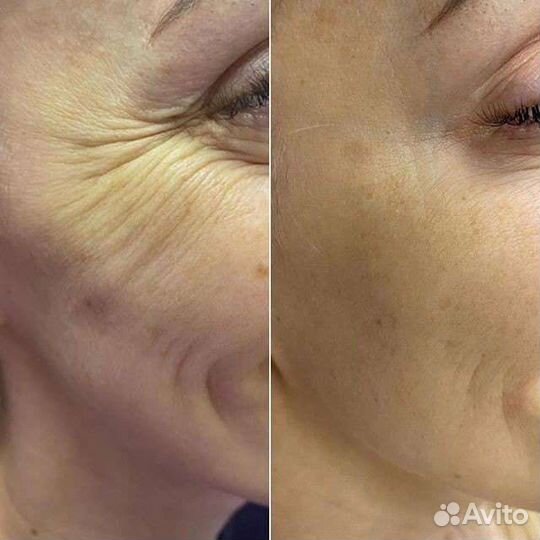 Шугаринг, косметолог