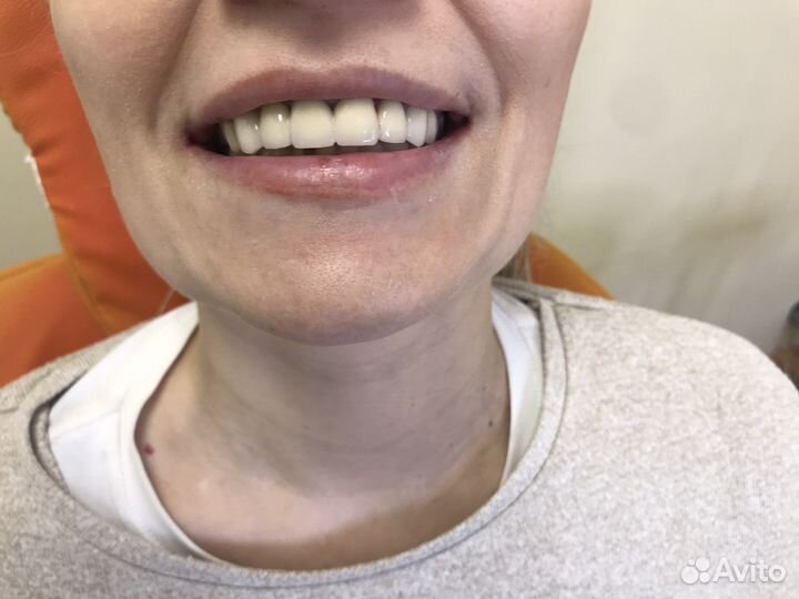 Починка зубного протеза