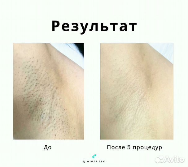 Аппарат для эпиляции Люминес максван 1200