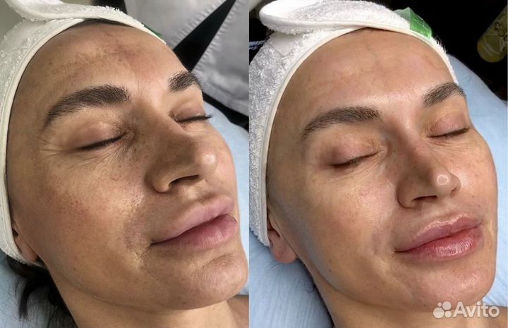 Безоперационная подтяжка лица