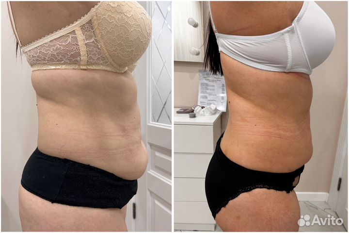 LPG массаж лица и тела