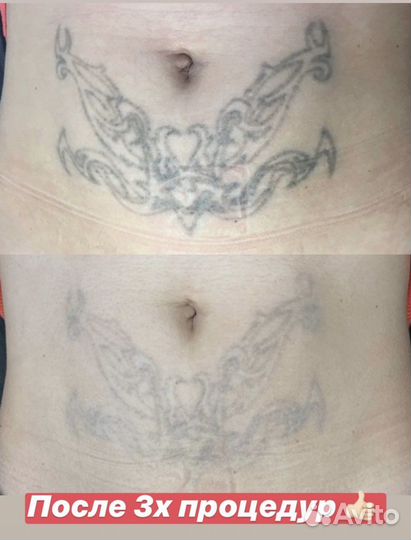 Удаление татуажа, тату, пилинг, лазерная эпиляция