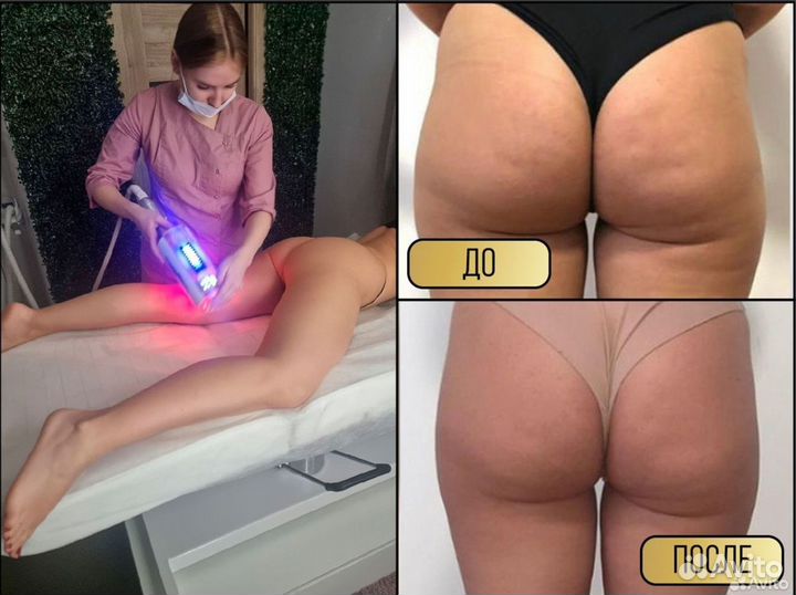 Массаж LPG / Эндошейп / Антицеллюлитный массаж