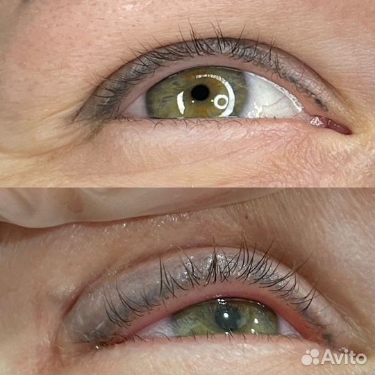 Удаление татуажа, татуировок,перманентного макияжа