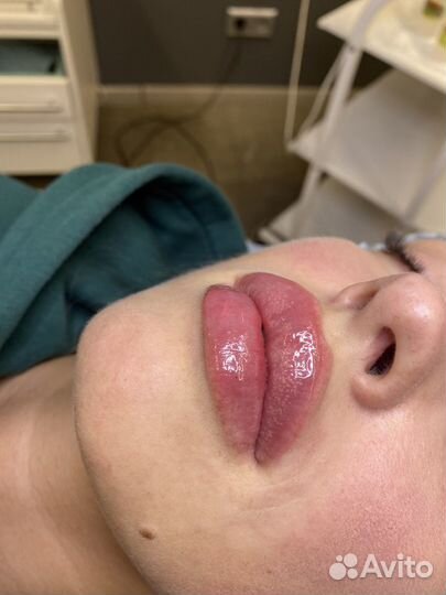 Модель на увеличения губ