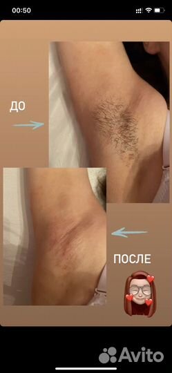 Депиляция воском