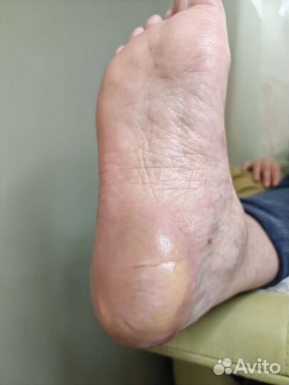 Коррекция вросшего ногтя