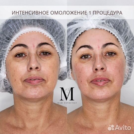 Омолаживающий массаж лица