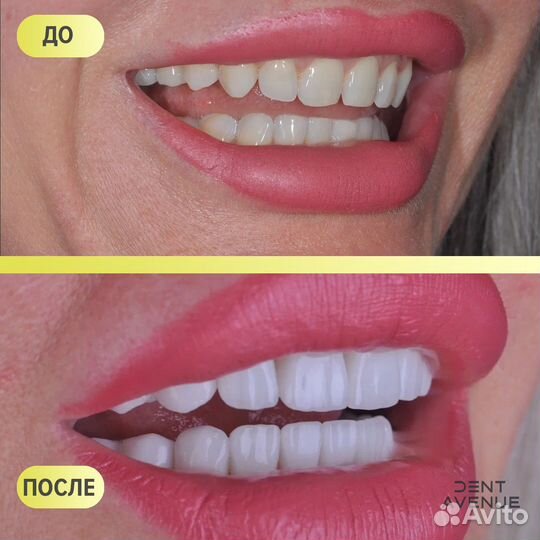 Виниры и коронки на зубы